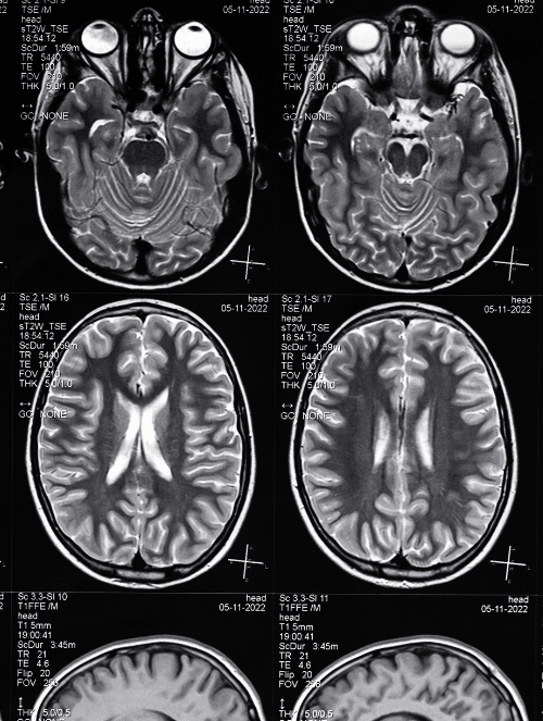 Traumatic Brain Injury in California