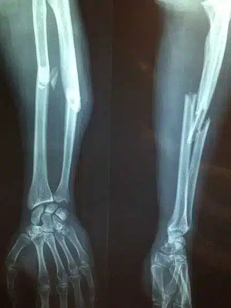 broken bones